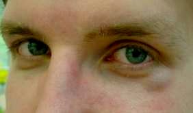 Thomas mit blauem Auge